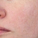 Tác hại của Retinol trên da nếu dùng sai liều lượng hoặc không đúng cách