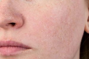 Tác hại của Retinol trên da nếu dùng sai liều lượng hoặc không đúng cách